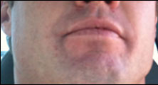 Hemet Bee Removal Guy Anthony right after being stung on the lip.