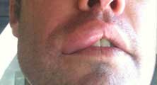 Hemet Bee Removal Guy Anthony picture of swelling after being stung 
    on the lip.